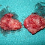 800px-Tonsillectomy_tonsils