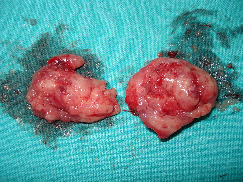 800px-Tonsillectomy_tonsils
